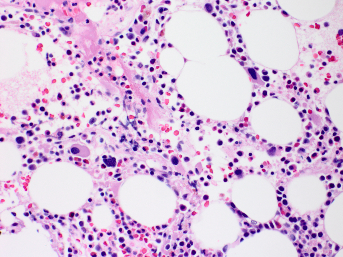 Bone marrow biopsy section showing many abnormal small megakaryocytes with hypolobated nuclei (x400, H&E) 